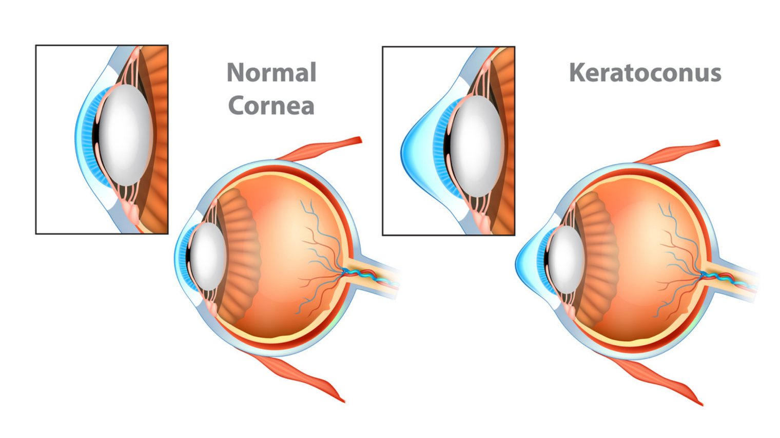 Image of a normal cornea vs a cornea with keratoconus