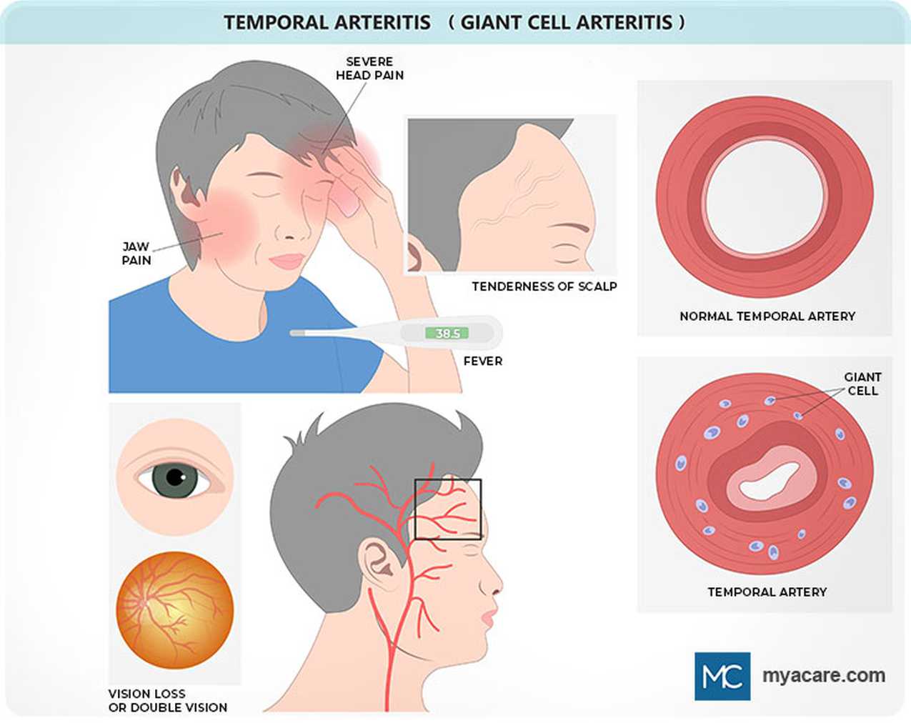 Giant Cell Arteritis Diagram