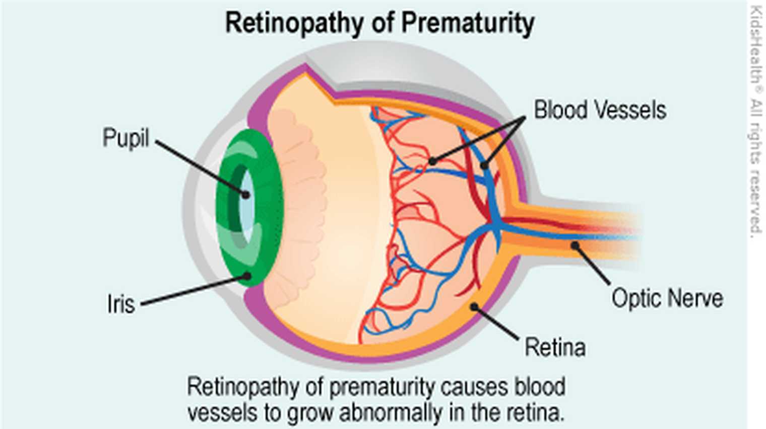 Retinopathy Of Prematurity Diagram
